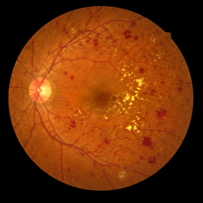 Retinal fundus image